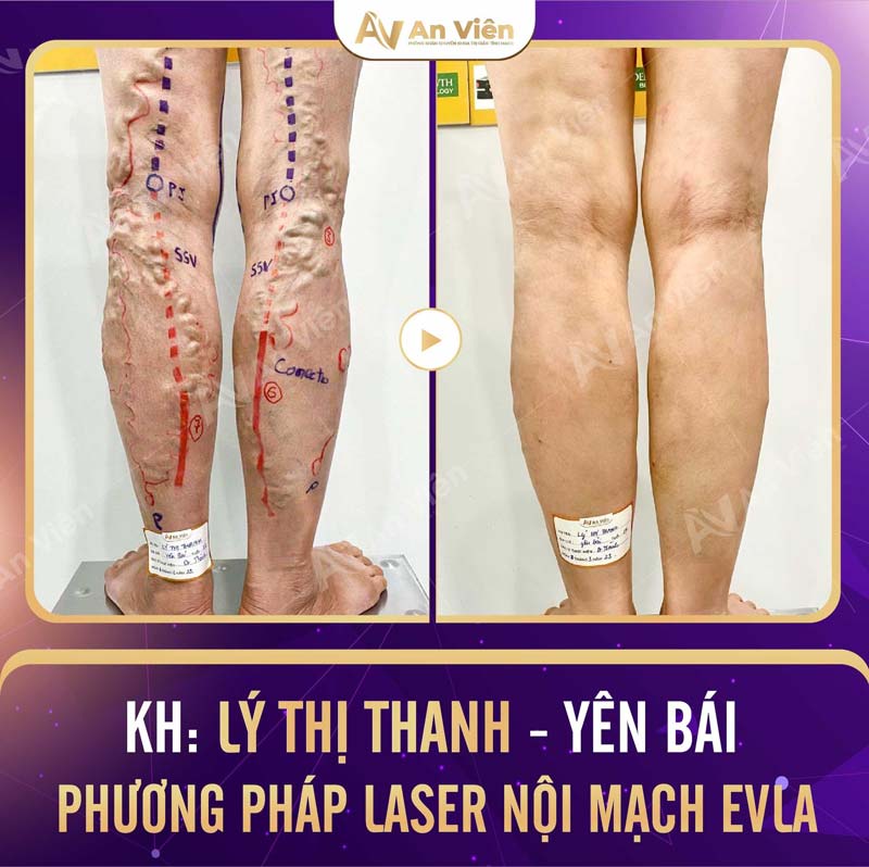 can thiệp laser một