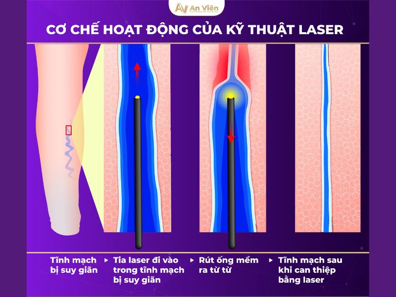 can thiệp laser, rf