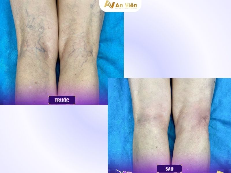 keo sinh học Venaseal