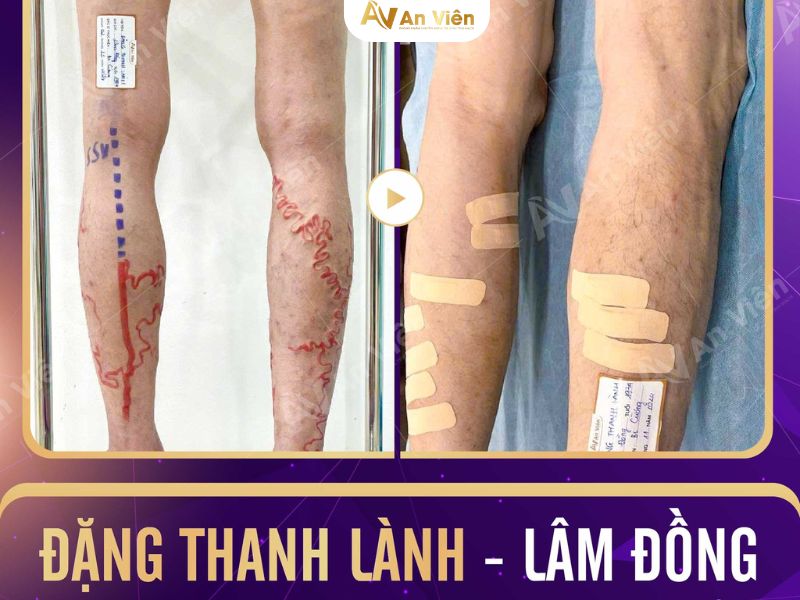keo sinh học Venaseal