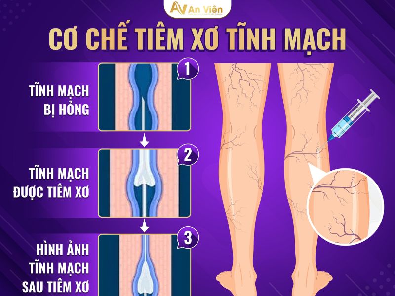 tiêm xơ tĩnh mạch