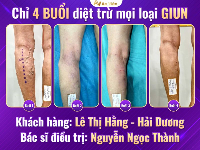 tiêm xơ tĩnh mạch lợi hay hại