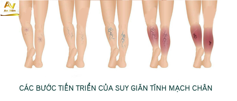 cấp độ tiến triển của suy giãn tĩnh mạch chân