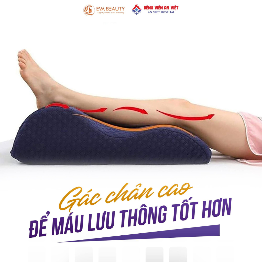 phương pháp trị giãn tĩnh mạch