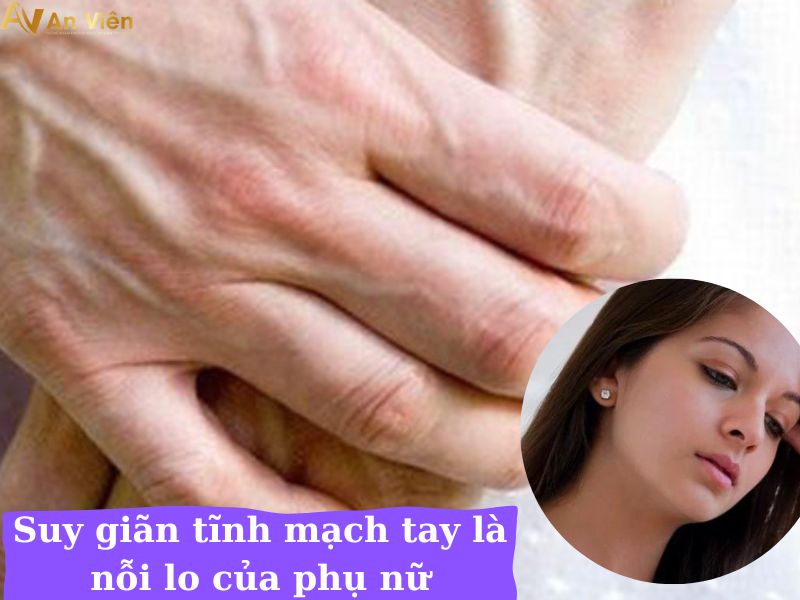 chữa trị giãn tĩnh mạch tay