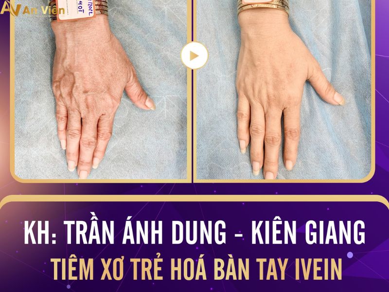 chữa trị giãn tĩnh mạch tay