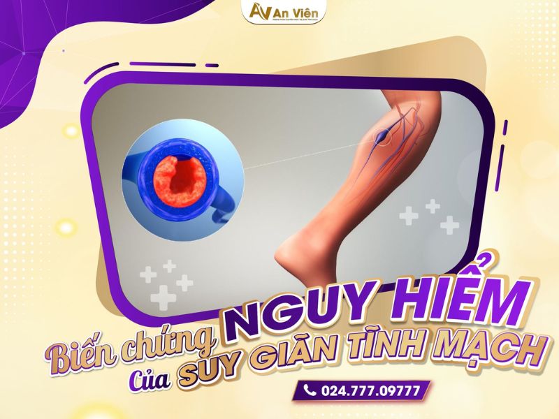 Đừng để loét chân do giãn tĩnh mạch