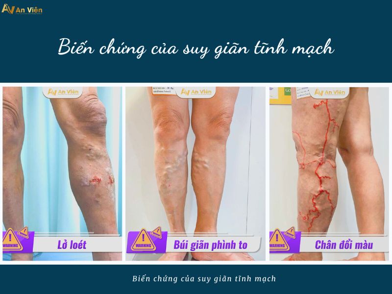 Đừng để loét chân do giãn tĩnh mạch