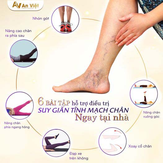 giãn tĩnh mạch chân là gì nên điều trị ở đâu
