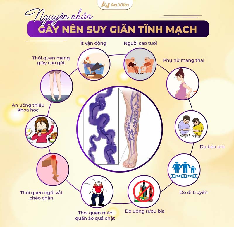 Giãn tĩnh mạch có di truyền không
