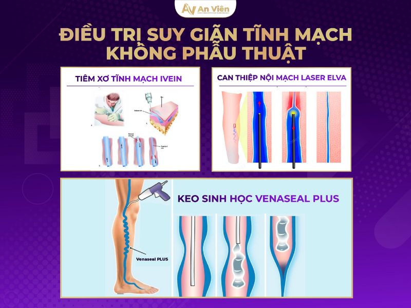 Giãn tĩnh mạch có di truyền không