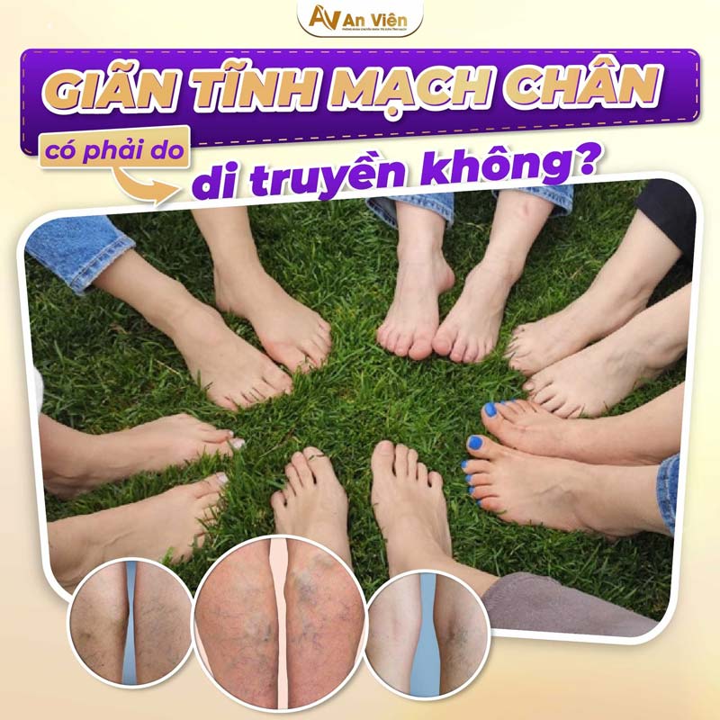 Giãn tĩnh mạch có di truyền không