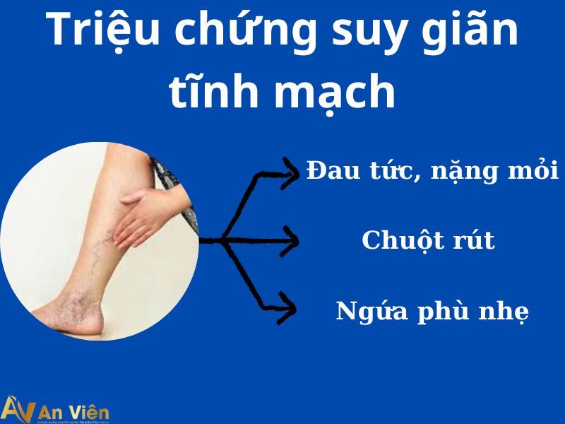 ngăn ngừa giãn tĩnh mạch