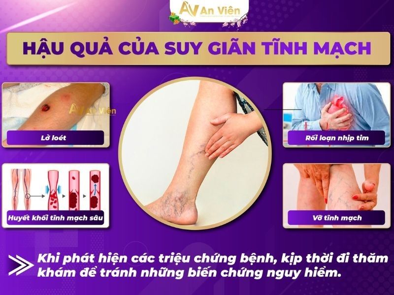 Nguyên nhân bị giãn tĩnh mạch