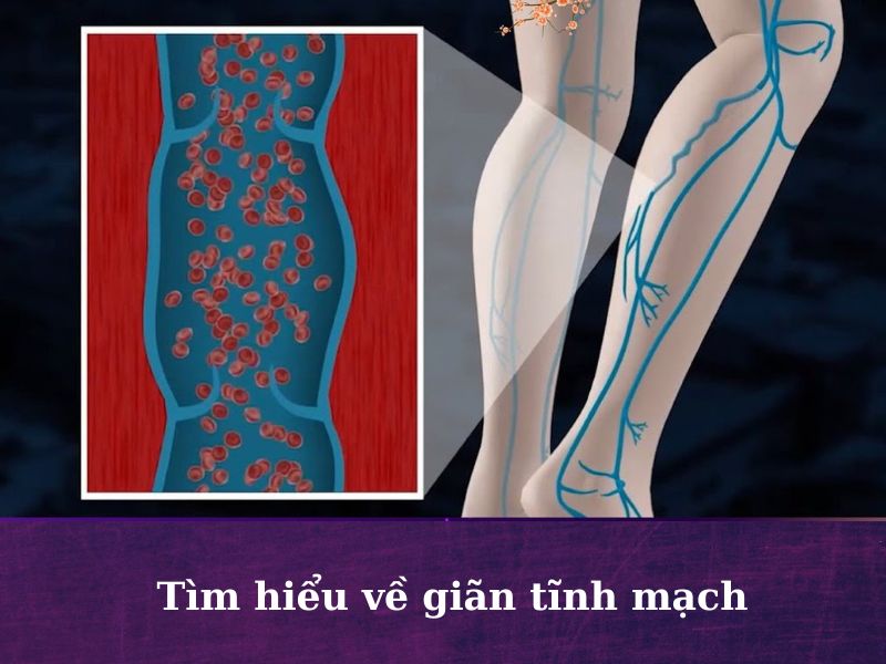 Nguyên nhân bị giãn tĩnh mạch