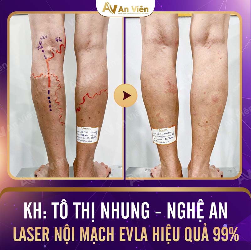 Nguyên nhân bị giãn tĩnh mạch