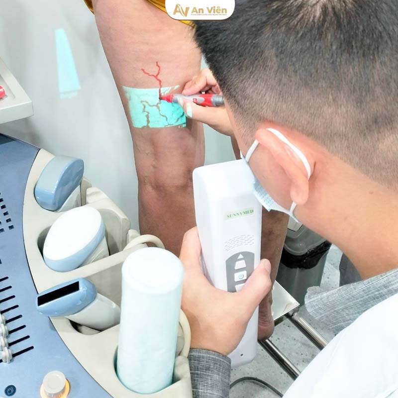 Nguyên nhân bị giãn tĩnh mạch