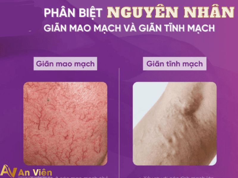 sự khác biệt giãn mao mạch và giãn tĩnh mạch