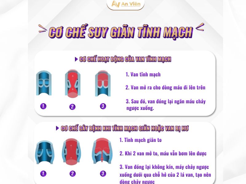 Suy giãn tĩnh mạch chân nên điều trị ở đâu