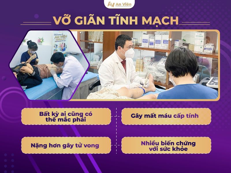 vỡ giãn tĩnh mạch