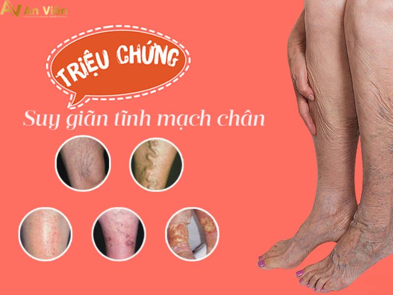 vỡ giãn tĩnh mạch