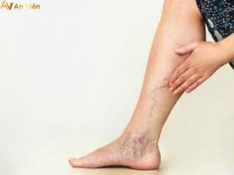 vỡ giãn tĩnh mạch