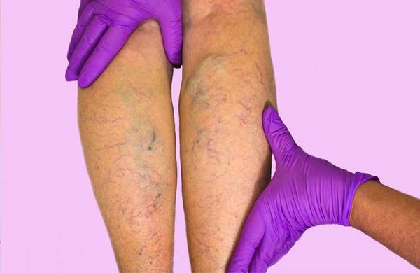 Viêm tắc tĩnh mạch vùng chân 