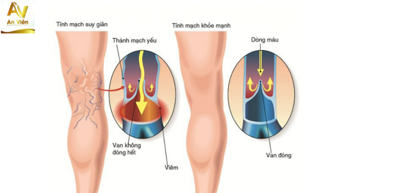 Bí quyết để giúp cải thiện người bị suy giãn tĩnh mạch tại nhà