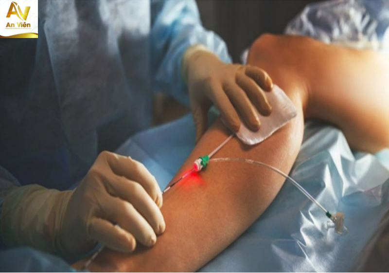Laser nội mạch