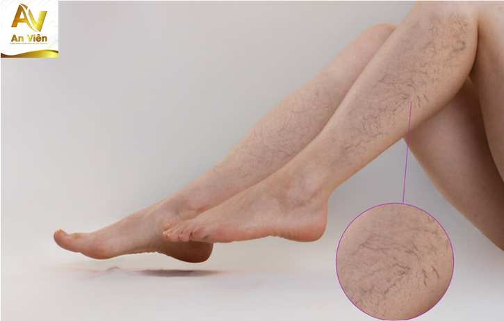 Suy giãn tĩnh mạch đến cuộc sống và công việc hàng ngày