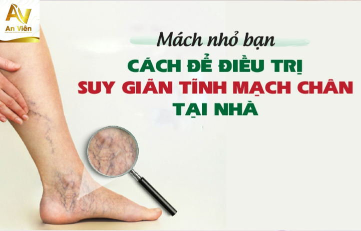 Phương pháp điều trị suy giãn tĩnh mạch chân tại nhà hiệu quả