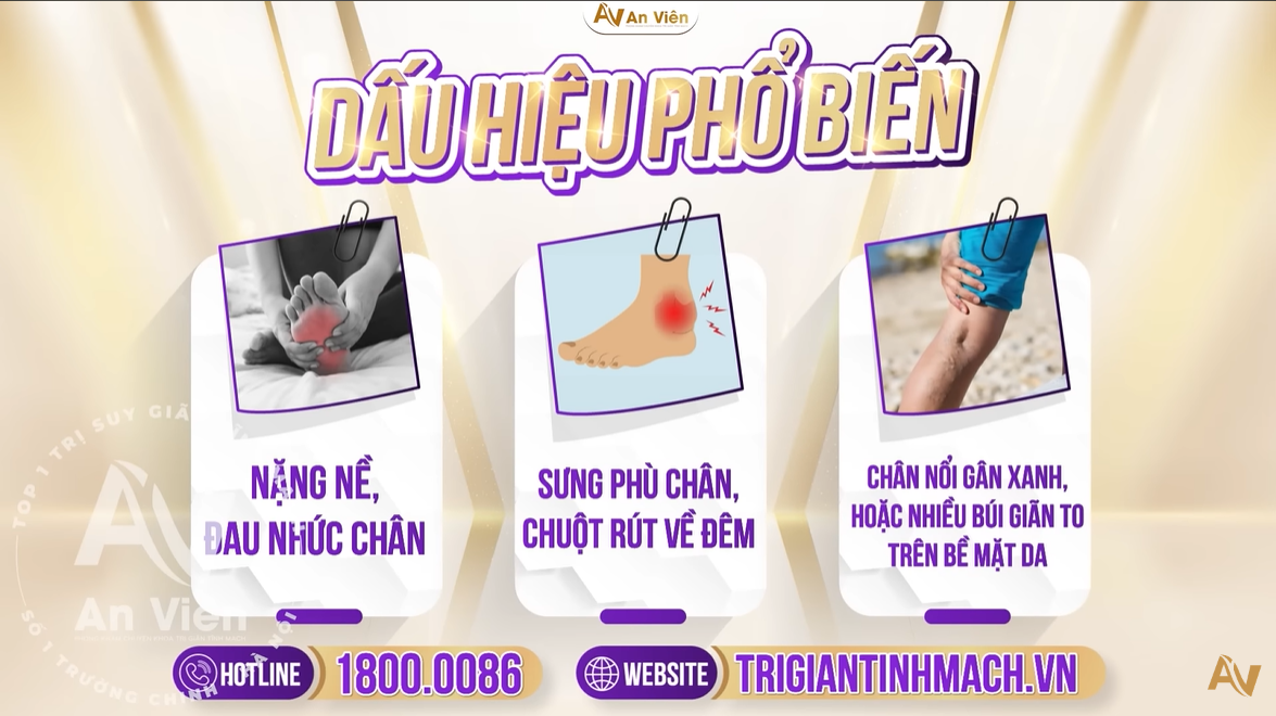 Những dấu hiệu phổ biến nhất của suy giãn tĩnh mạch sâu