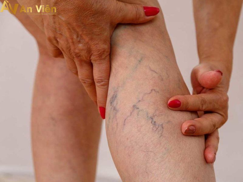 Nổi gân xanh ở bắp chân