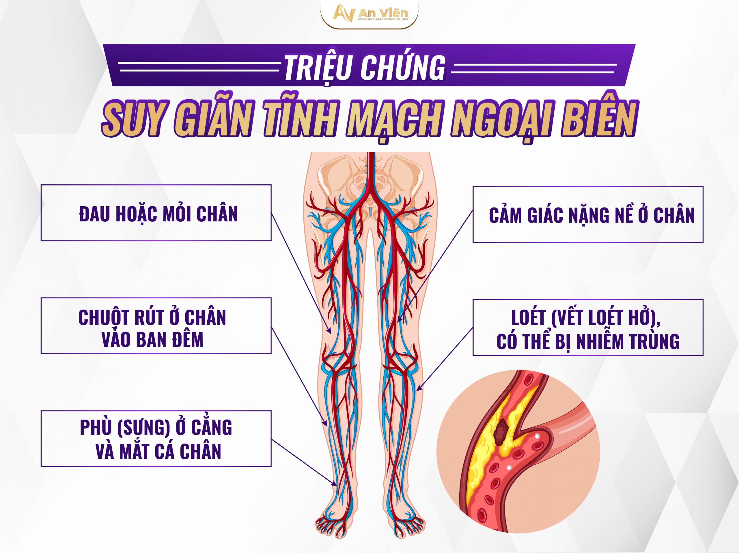 Triệu chứng suy giãn tĩnh mạch ngoại biên