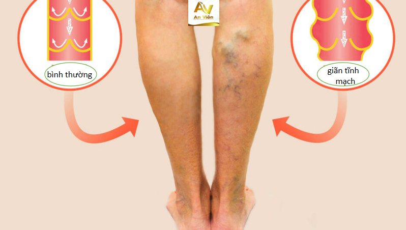 Hình ảnh: giãn tĩnh mạch ảnh hưởng đến sức khỏe