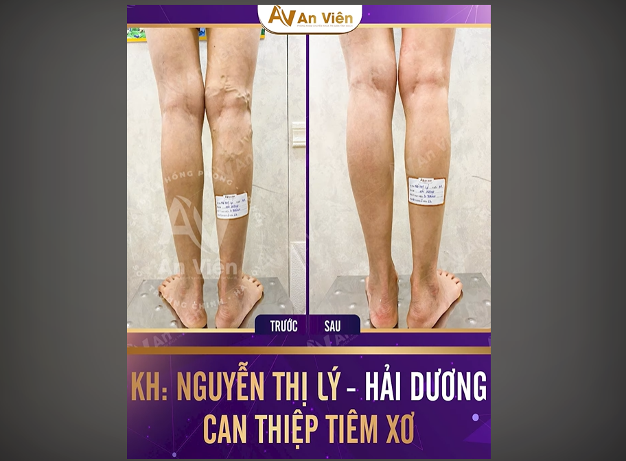 Phương pháp can thiệp tiêm xơ