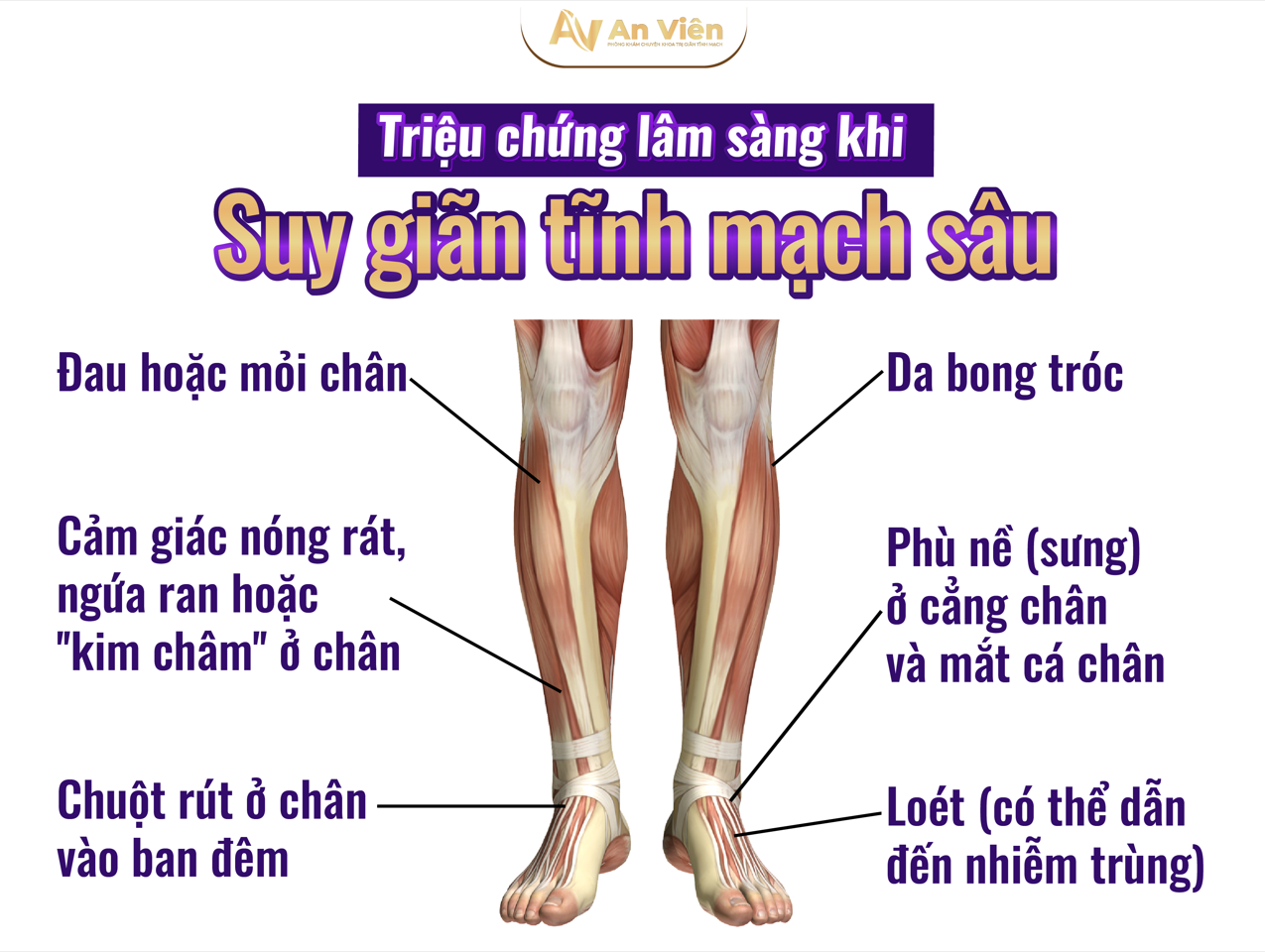 triệu chứng lâm sàn khi bị suy giãn tĩnh mạch là gì?