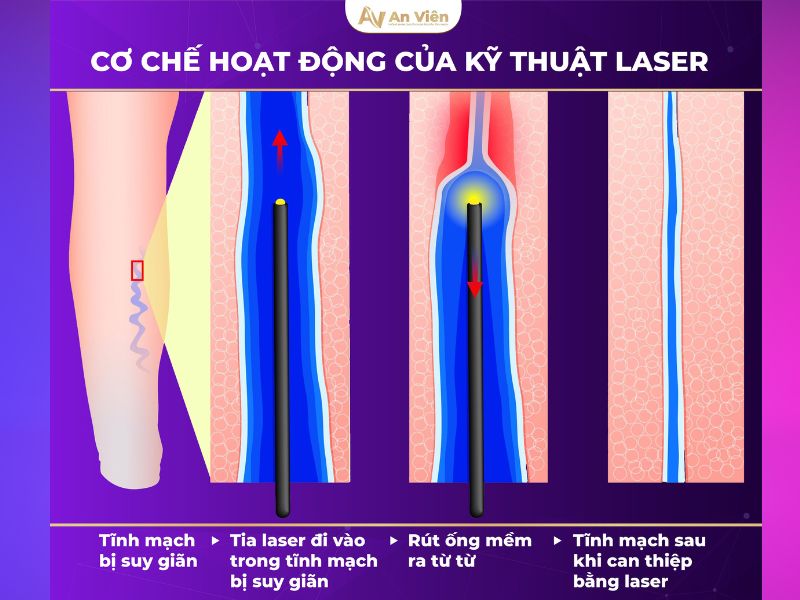 Can thiệp laser