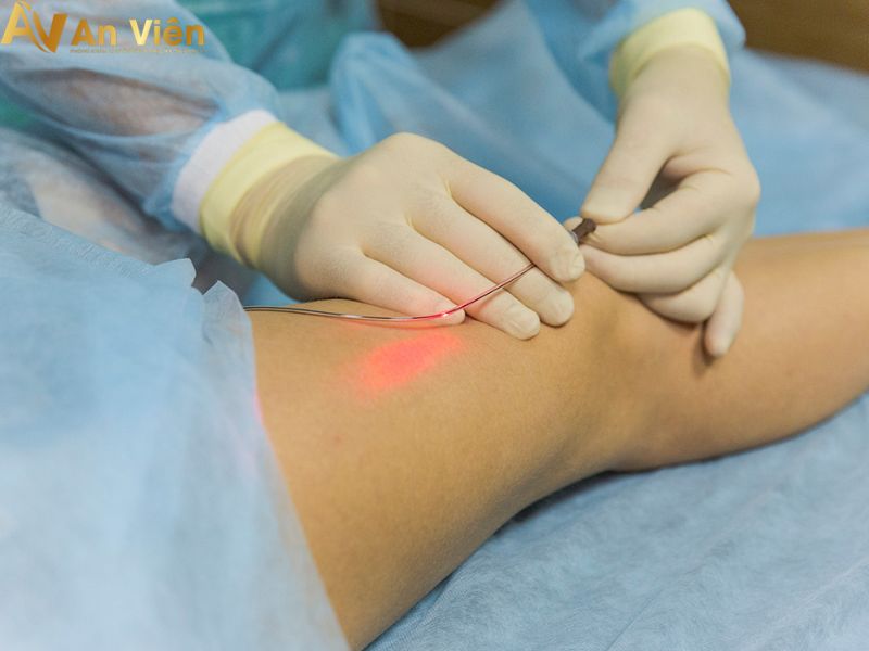 Phương pháp Laser-RF