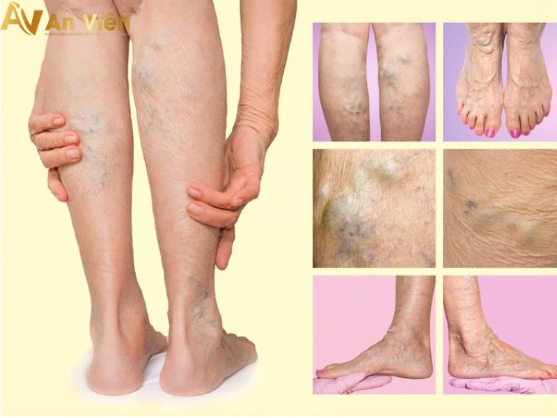 giãn tĩnh mạch ngoại biên có nghiêm trọng không?