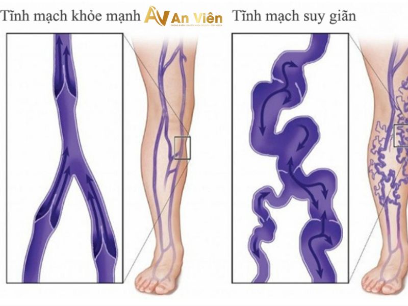 Tĩnh mạch khỏe mạnh và tĩnh mạch bị suy giãn
