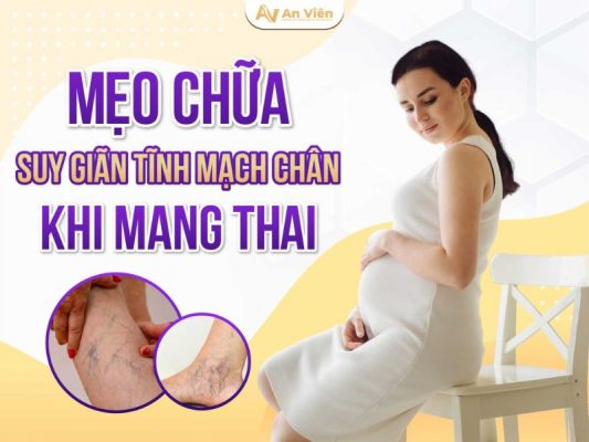 mẹo chữa suy giãn tĩnh mạch chân khi mang thai