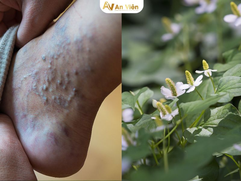 rau diếp cá có trị giãn tĩnh mạch không