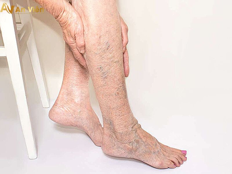 Hình ảnh: giãn tĩnh mạch chân
