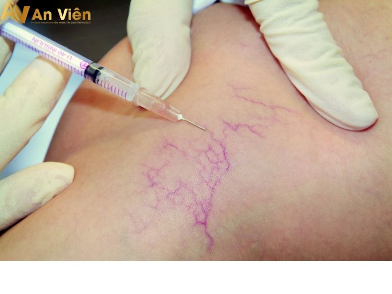 Tiêm xơ tĩnh mạch tại An Viên