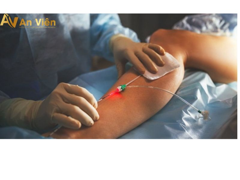 Can thiệp Laser - RF