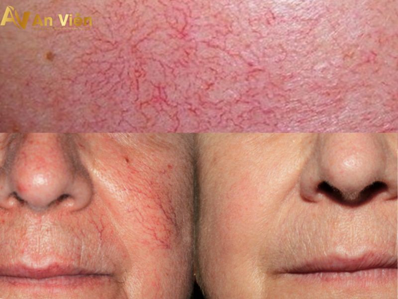Hình ảnh: Người bệnh sau khi sử dụng phương pháp laser