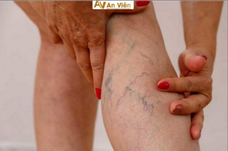 chữa giãn tĩnh mạch chân