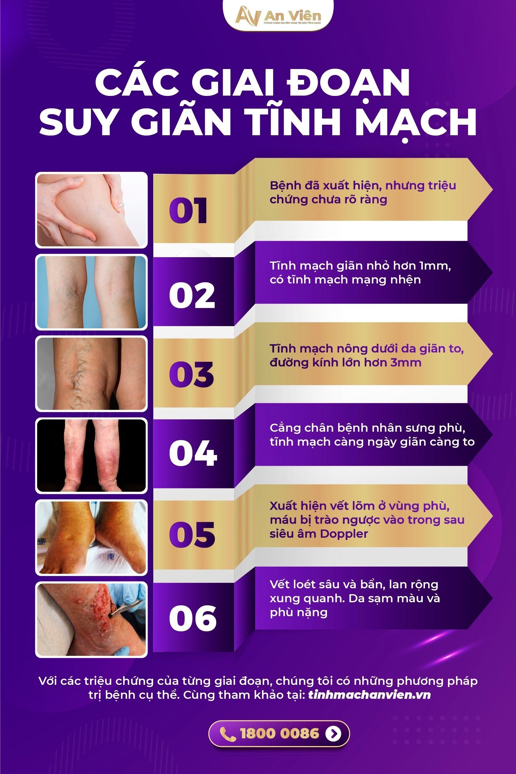 Các giai đoạn suy giãn tĩnh mạch