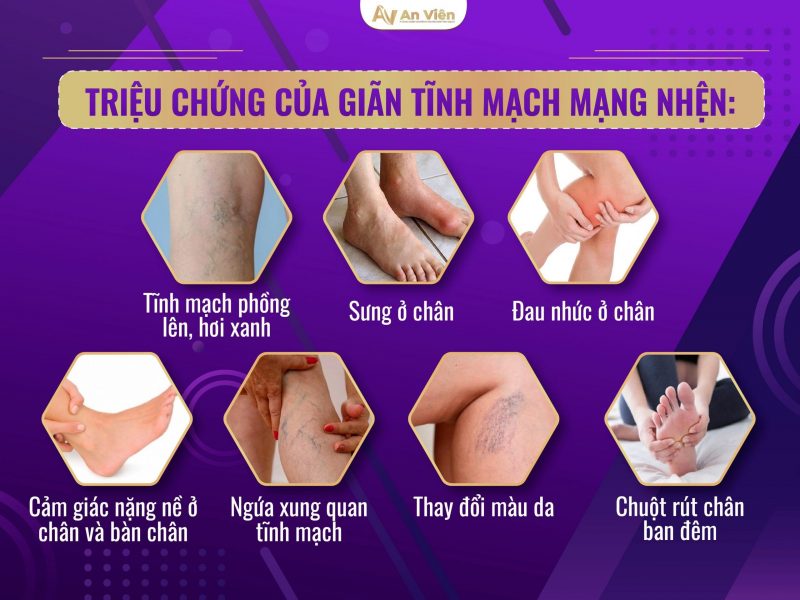 Triệu chứng của giãn tĩnh mạch mạng nhện